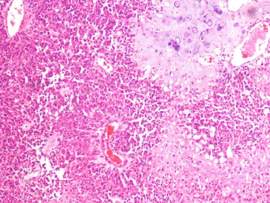 Sarcomatoid Carcinoma of the Urinary Bladder 4 patients were males and one was a female. Their median age was 72.8 years (range, 60-79 years), and most of the patients were older than 70 years.