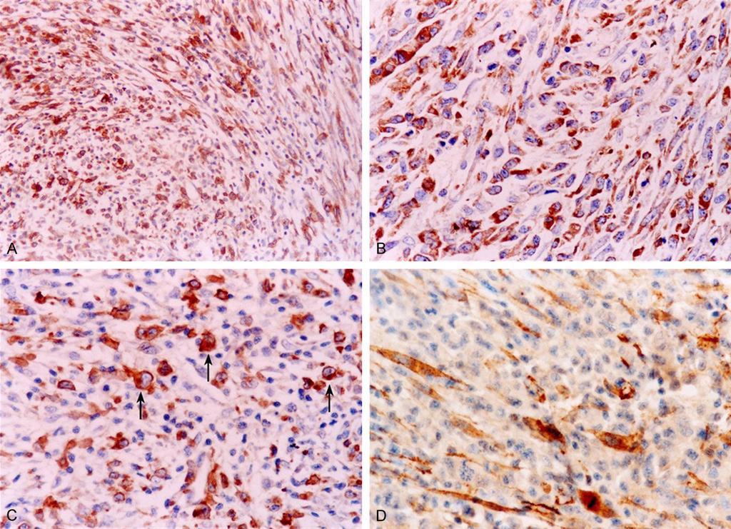 Figure 2. IHC assay. A. Neoplasm cells were strongly positive for ALK-1 (100 ). B. Neoplasm cells were strongly positive for EMA (400 ). C. Neoplasm cells were strongly positive for CD30.