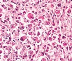 A, Fascicular pattern of spindle cells (H&E,