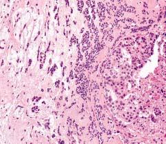 Anatomic Pathology / ORIGINAL ARTICLE Image 4 Transitional zone between carcinomatous and sarcomatoid elements in sarcomatoid salivary duct carcinoma (H&E, 400).