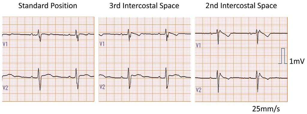 Risk Assessment in BrS 315 Figure 6. Electrocardiogram (V1 and V2) of a patient with a history of syncope who developed ventricular fibrillation during the follow-up.