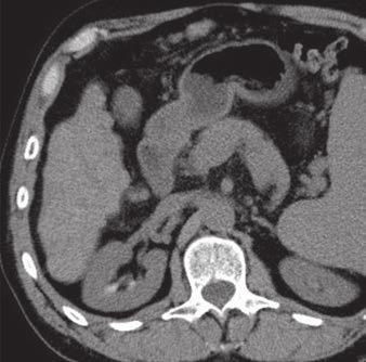Jang et al. Fig. 2 61-year-old man with hepatitis B detected on surveillance ultrasound. A D, Quadriphasic CT images show 1.8-cm hepatic nodule.