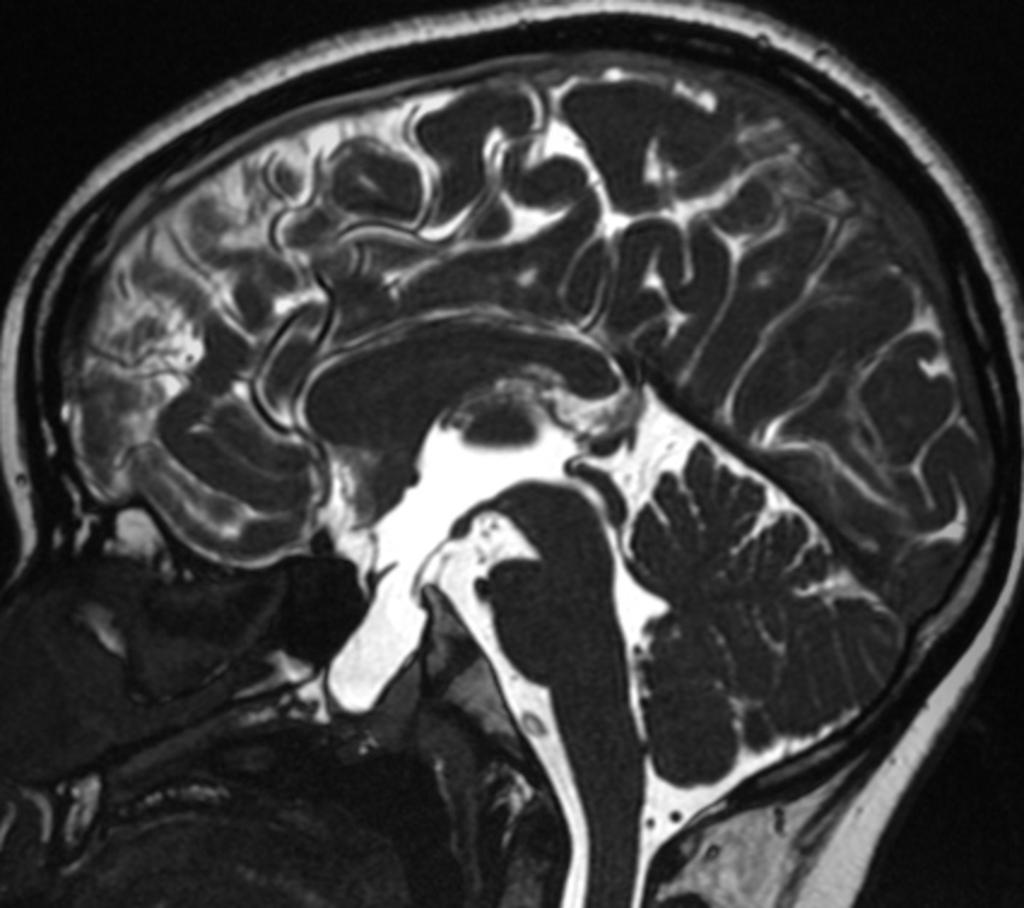 Fig. 12: Sagital T2-weighted image of a sphenoetmoidal encephalocele containing brain tissue, extending into