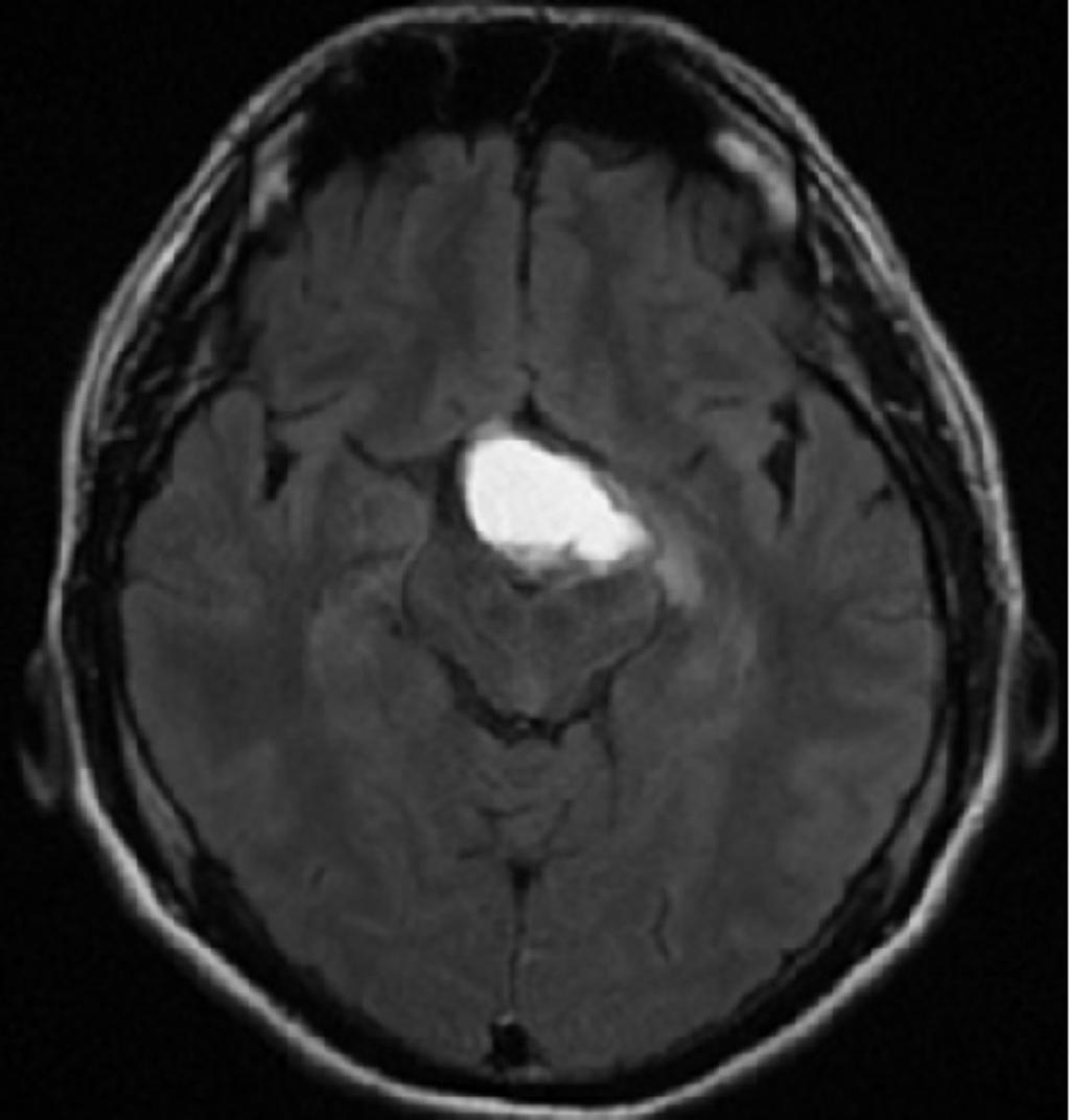 Fig. 9: Axial FLAIR image of the same craniopharyngioma