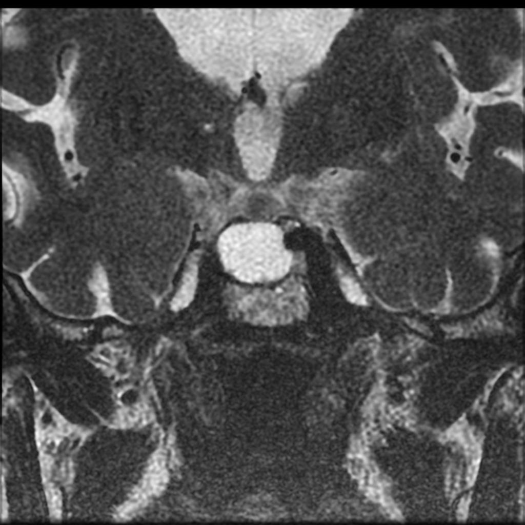 Fig. 17: Coronal T2-weighted image of a cyst of Rathke's pouch.