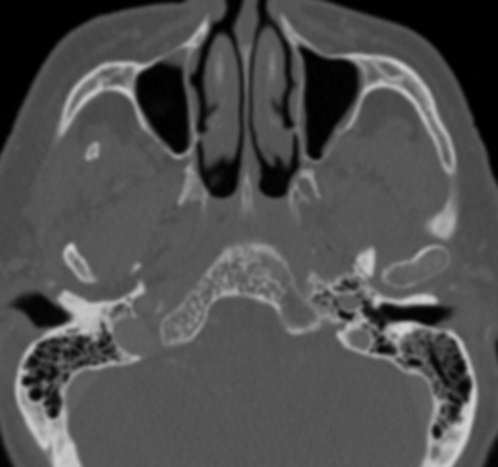 Fig. 11: Axial CT bone scan of an intraosseous hemangioma of the clivus.