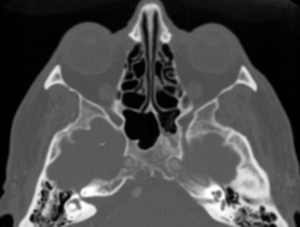 Fig. 16: Axial CT bone scan of echordosis physaliphora shows a bony irregularity
