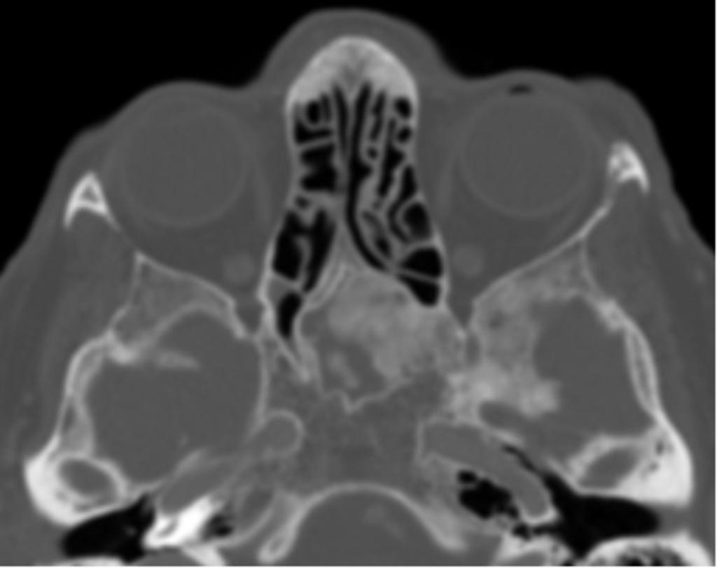 Fig. 14: Fibrous dysplasia of the sphenoid.