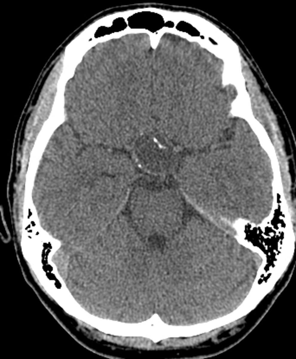 Fig. 8: Axial CT without contrast of a craniopharynigoma shows a suprasellar mass with a