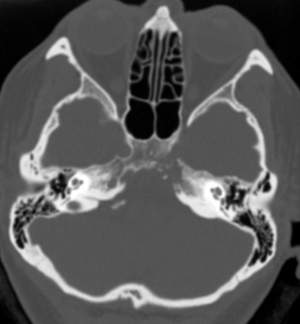 Fig. 3: CT bone scan of a chondrosarcoma arising in the left petroocipital fissure.