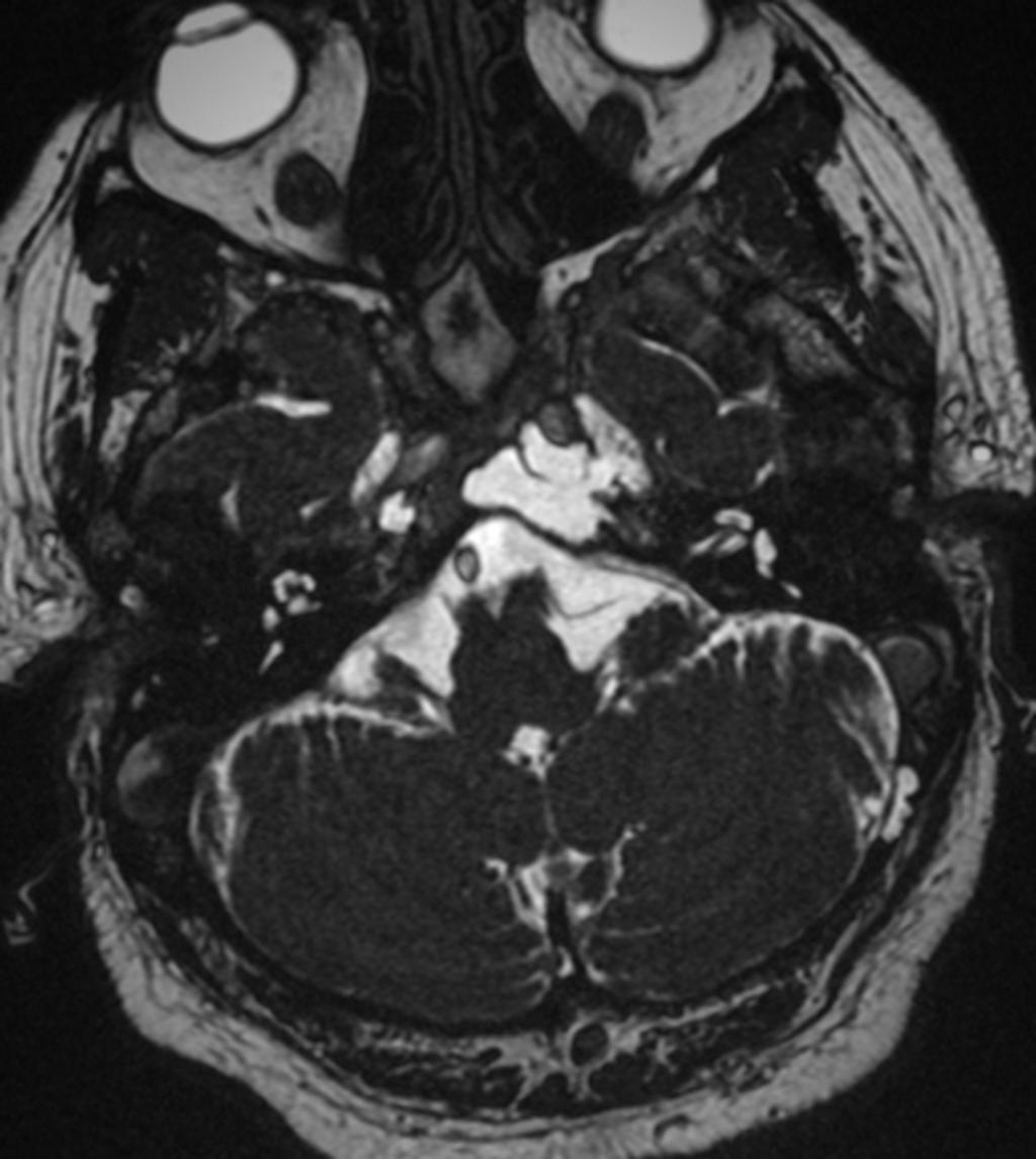 Fig. 13: Axial T2-weighted image of a petroclival cephalocele.