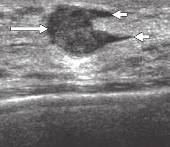 , In 47-year-old woman who presented with palpable mass, ultrasound image shows well-defined oval-shaped nodule (arrow) adjacent to nipple (asterisk).