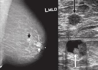 Retroareolar nodule (short white arrow) corresponds on ultrasound to complex cyst with mural based nodule (long white arrow), which at pathology was sclerosing papilloma.