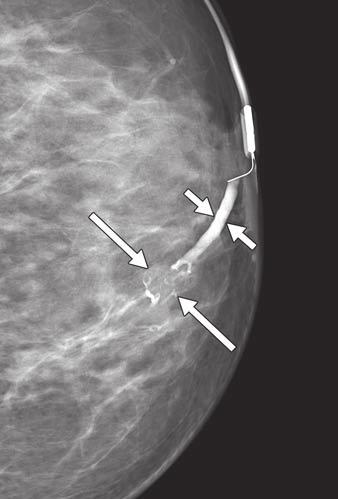 Linear enhancement is also seen within left breast (long arrow).
