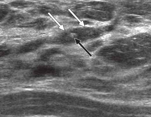 , Galactogram shows intraductal nodule (white arrows) with single fleck of calcification (black arrow).