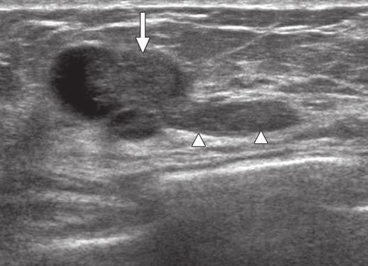 Excision showed ductal carcinoma in situ arising in papilloma with extension into surrounding tissues. Fig.