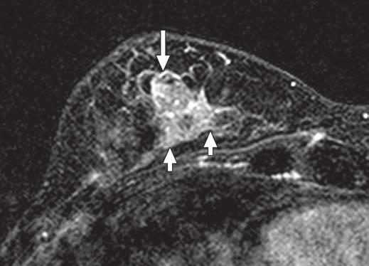 , Ultrasound image shows complex cystic structure with mural-based nodule (arrow) and intraductal extension (arrowheads).