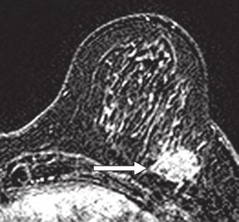and, Solid papillary carcinoma in 48-year-old woman, who presented with palpable breast lump.