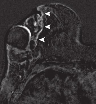 Ultrasound image (E) shows complex cyst with thick internal septations and solid central component