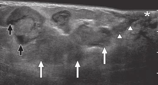 , Ultrasound image in 47-year-old woman shows debris (arrows) within dilated duct that has appearance of multiple intraductal papillomas.