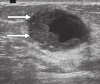 , Ultrasound image in 52-year-old woman shows fat necrosis with cystic and solid regions mimicking intracystic papillary lesion. Fig.
