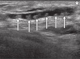 Ultrasound image shows lobulated well-defined hypoechoic mass (white arrows) with cystic regions (black arrows) and extension in ductal