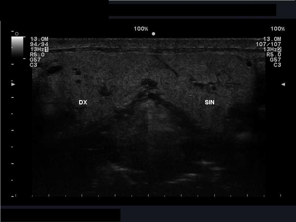 Page of 0 Journal of Clinical Ultrasound 0 Figure Axial sonogram shows diffuse