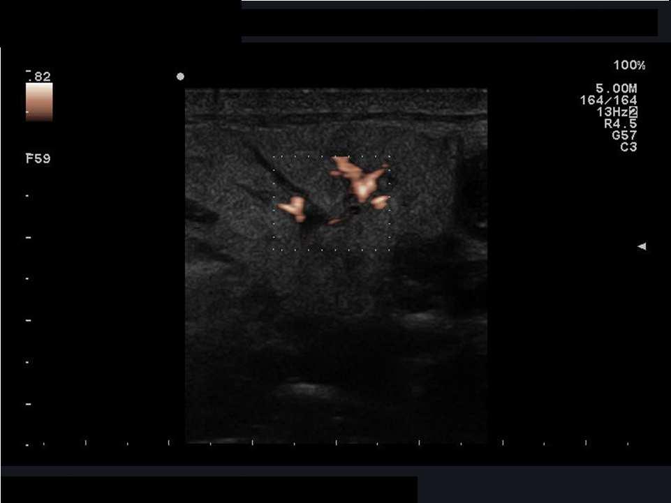 Journal of Clinical Ultrasound Page 0 of 0 0 Figure Axial Power Doppler sonogram shows