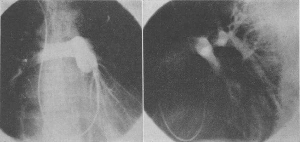 Pulmonary Valve Replacement with Fascia Lata A B FIG. 4. Posteroanterior (A) and lateral (B) pulmonary artery angiograms of a patient in whom a fascia lata pulmonary valve has been inserted.