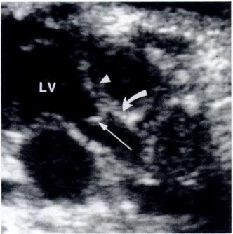 Ventricular septum is intact and tricuspid valve (straight arrow) inserts slightly more apically on septum than does mitral valve. Septum primum (arrowhead) is seen in left atrium (LA).
