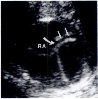 1254 BROWN ET AL. AJR:160, June 1993 Entrance of Coronary Sinus into Right Atrium The coronary sinus returns venous blood from the myocandium to the right atrium.