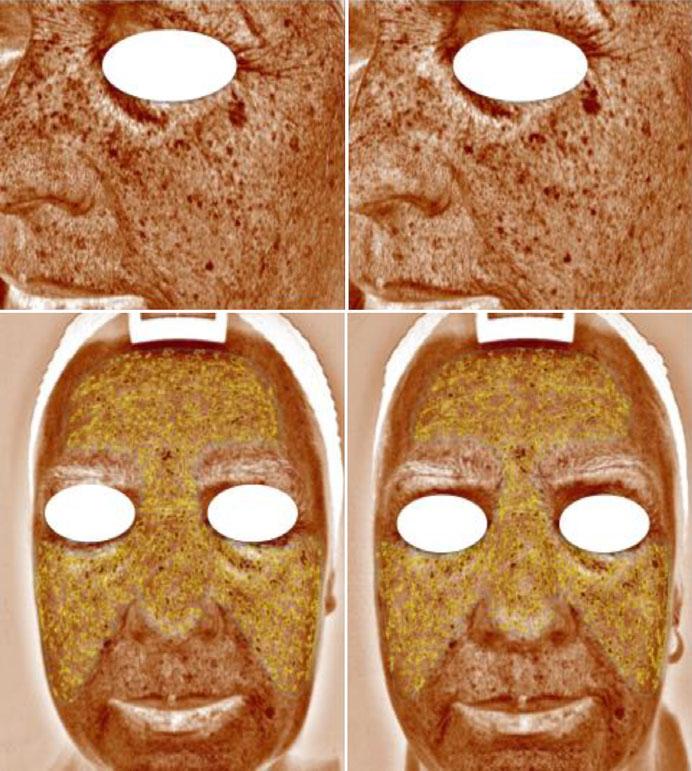 number - brown spots (patient BK) measure before the application (D0) Measurement after 6- weeks (D42) difference after 6- weeks (D42) Left profile 325 282-43 Right profile 324 287-37 En face 527