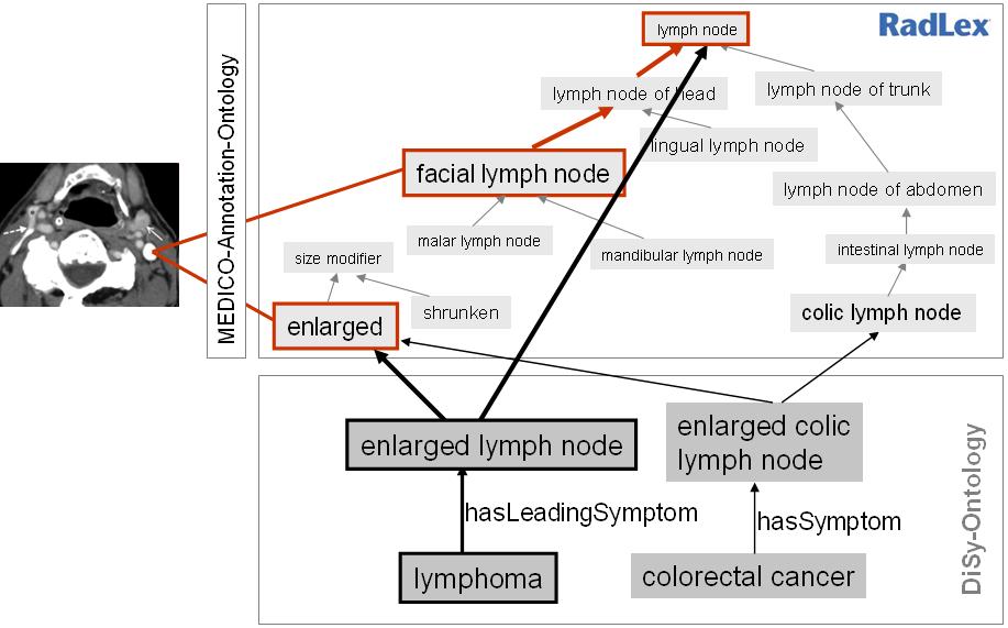 4 THE DISEASE-SYMPTOM-ONTOLOGY Our goal is to establish a knowledge model able to represent information contained in Herold s Innere Medizin necessary for clinical diagnosis.