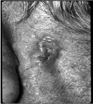 ULCERATED LESIONS MOSTLY IN FOLDS 21 RESOLVED PROSPECTIVE, RANDOMIZED STUDIES NEEDED