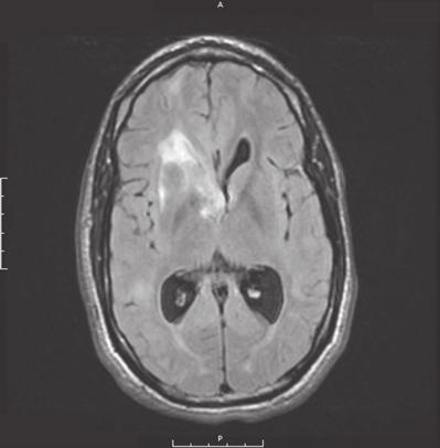A B R L R L C D R L R L Figure 1. Effect of Everolimus on Subependymal Giant-Cell Astrocytoma (SEGA) in Two Patients.