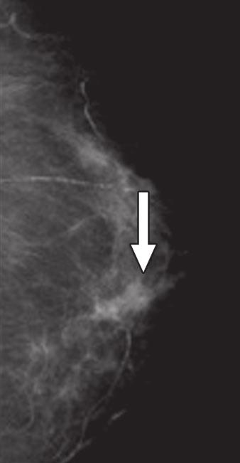 solitary dilated duct could not be assessed. Previous mammography examinations were available for comparison for the other nine solitary dilated duct B D Fig.