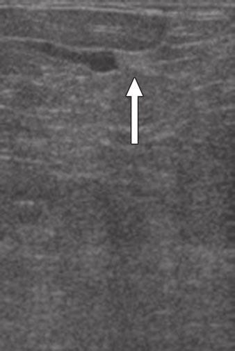 Although ultrasound is not examined in this article, this case illustrates sonographic finding of solitary dilated duct.
