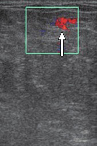 C, Transverse sonogram shows dilated duct corresponding to A and B, with echogenic filling defect representing intraluminal mass (arrow).