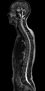 Spinal Cord MRI scans also prove useful in investigating injuries and conditions of the spinal cord. It accurately images both the interior spinal cord itself and the vertebrae and disks of the spine.