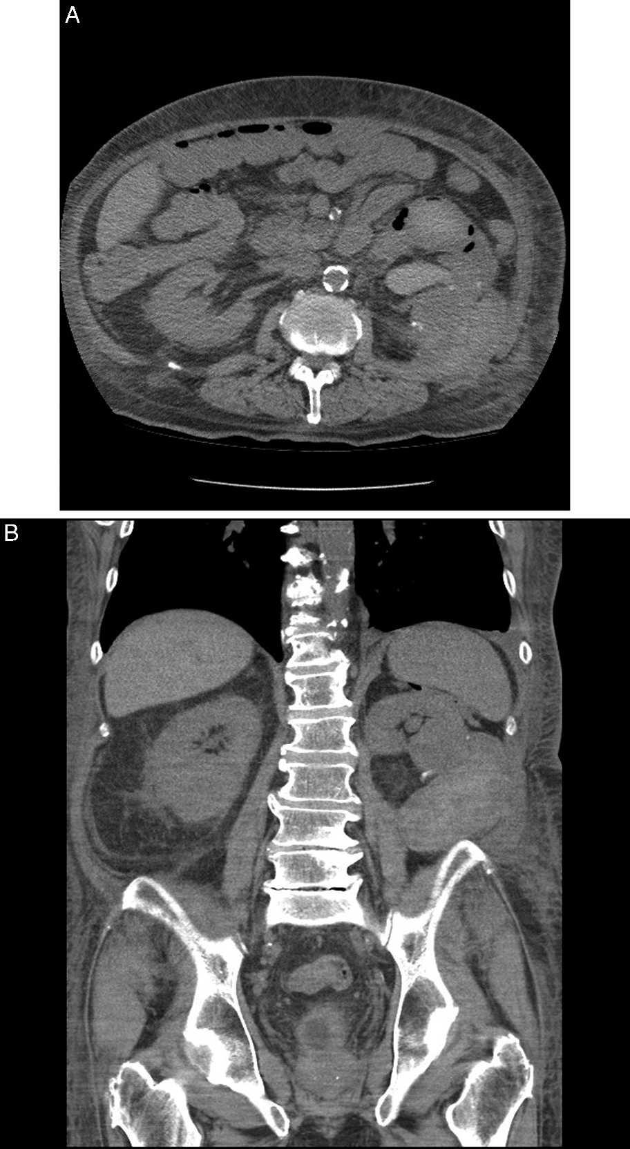 Renal Artery Embolization Figure 1. Noncontrast computed tomography images obtained on postoperative day 23.