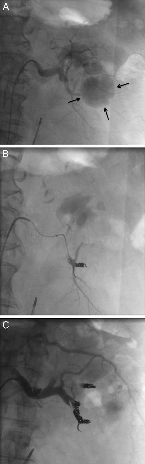 Irwine, C patient s clinical presentation, suggested a renal artery pseudoaneurysm as opposed to arteriovenous fistula. Interventional Radiology was consulted.