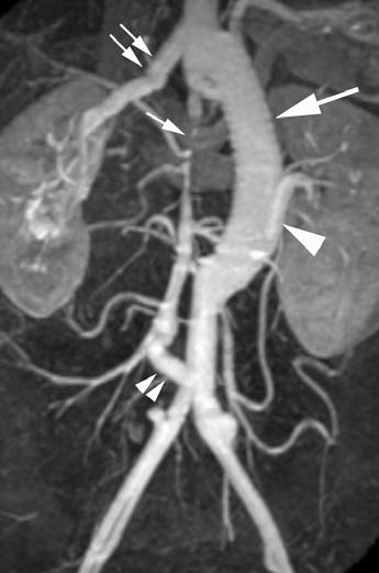 45-year-old-woman with Takayasu s arteritis and graft placement for abdominal aortic occlusion.
