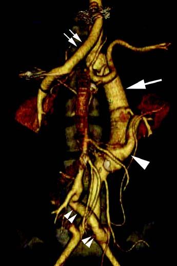 graft (single large arrow) and supraceliac aorta-to-right renal artery bypass graft (double small arrows) with occlusion (single small