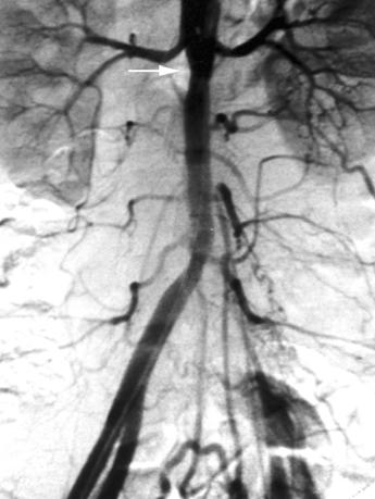 Left renal artery is supplied via bypass graft (single arrowhead).