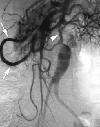 Imaging of Takayasu s rteritis Fig. 5. 52-year-old woman with Takayasu s arteritis.