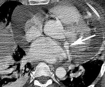 , Thoracic CT angiogram obtained caudal to shows large aneurysm (arrow) of