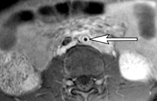 Unenhanced CT scan shows extensive calcification (arrow) composing abdominal aortic lumen.