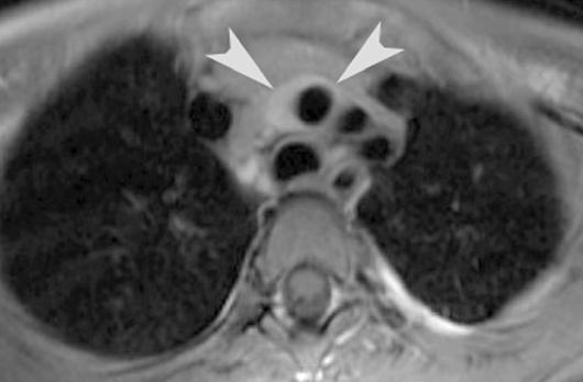 , xial T1-weighted MR image (TR/TE, 500/20) obtained through superior mediastinum shows