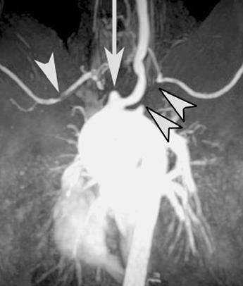 Gotway et al. Fig. 13. 50-year-old woman with Takayasu s arteritis. Coronal MR angiogram shows short-segment occlusion of infrarenal abdominal aorta (long arrow).