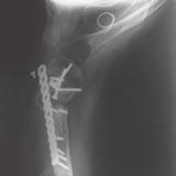 fracture situations. For grossly deficient rotator cuff, a polyethylene articular surface is snapped onto the proximal face of the stem.
